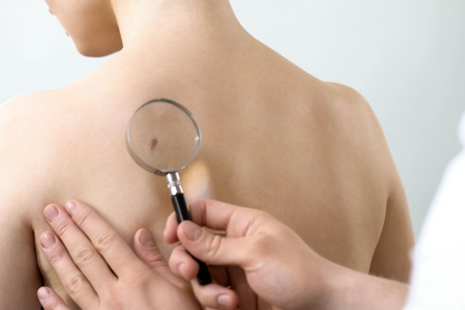 Doctor checking a mole on a person